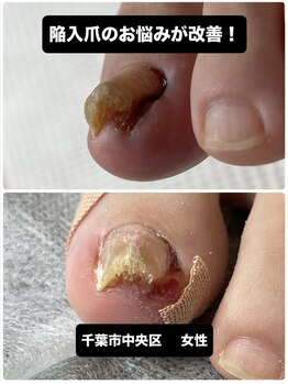 巻き爪じゅん 千葉駅前店/陥入爪の痛みを根本から改善！