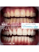 ホワイトニングサロン 福岡天神店/ホワイトニング