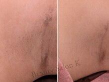 ケイ(K)/《毛穴》ワキ黒ずみ改善