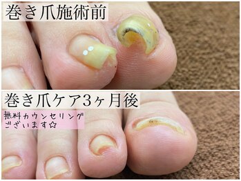 巻き爪専門スタッフ施術効果◎