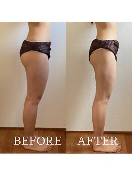 ブルーム(BLOOM)/エレクトロリンパマッサージ１回