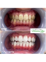 ホワイトニングサロン 名古屋駅店/【ホワイトニング施術例】