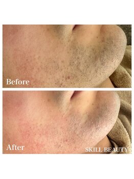 スキル アイラッシュ(SKILL eyelash)/メンズ脱毛☆ヒゲ