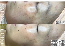 サロン ヒゴロ(SALON HIGORO)/シミケア