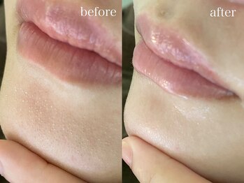 テオリア(TEORIA)/顎の汚れもスッキリ♪