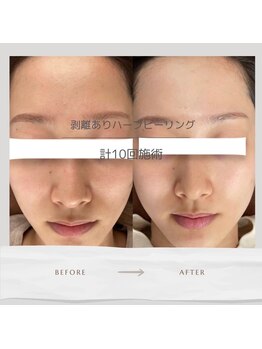 べっぷ餅ヶ浜鍼灸院/ハーブピーリングBefore/ After