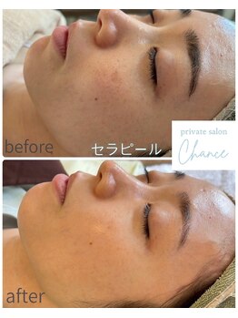 シャンス(Chance)/セラピール症例