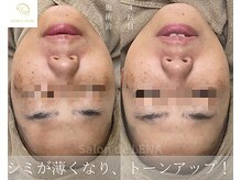 サロンドレナ 名駅店/ハーブピーリング サロンドレナ