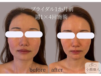 小顔職人/ 小顔ビフォーアフター/30代