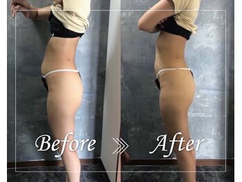 ウィンウィン 新山口店(Win Win)/WINBACK痩身1部1回