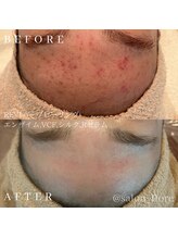 フローレ 平針店(Flore)/トラブルを繰り返さないお肌に