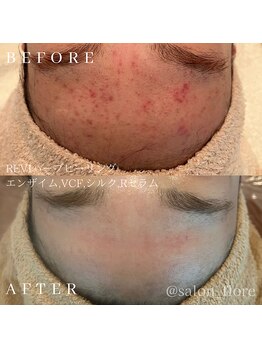 フローレ 平針店(Flore)/トラブルを繰り返さないお肌に