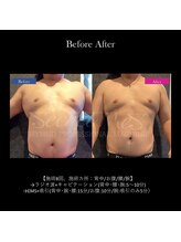 ヴェリー(VARY)/痩身ビフォーアフター