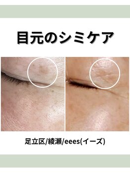 イーズ(eees)/目元のシミケア