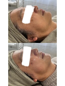 アレイズ(ARAYS)/症例(小顔矯正)