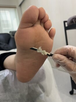 HALUTE.86【4/9 NEW OPEN (予定)】の写真/SNSでも話題!【韓国式足裏角質ケア】でツルふわの足へ◇足裏のタコや魚の目にも◎お気軽にご相談下さい♪