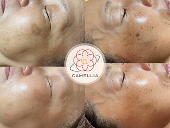 リラクビューティー カメリア(Camellia)の写真/ピンポイントに当てられるからここを取りたい方にオススメ★低周波シミケアとピーリングでシミしわ改善！