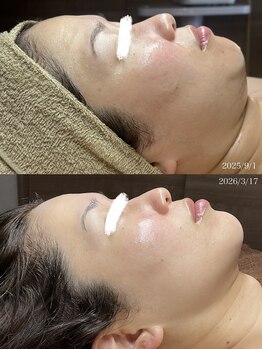 ベル(Belle)の写真/【痛みなし脂肪分解レモンボトル】なかなか落ちてくれない二重顎のもたつき、口横のプニッ汗!!を撃退＾＾

