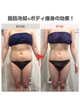 ビーフィール 千葉店(be feel)/脂肪冷却＋ボディの効果