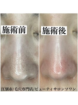 ソワン(Soin)/毛穴エクストラクション