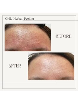 ラノン(Ranon)/肌荒れケアには漢方ピーリング