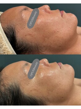 オーパス ビューティー(OPUS Beauty)/タラソトリートメント