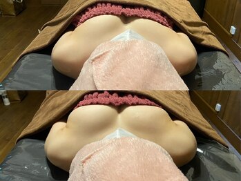 リノレア(LinoLea)/左右差改善