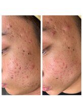 リンドール(RinDoll)/ダイエット/痩身/耳つぼ