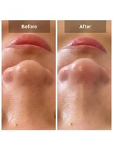 サロン ド アヤ(salon de Aya)/【毛穴洗浄】2回ケアしたお客様