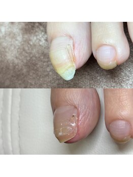 巻き爪矯正1回目(左親指)