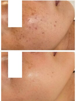 リセル(RE.cell)/シミケア6回+肌質改善2回