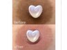 【話題のローマピンク】乳輪ちくび★メラニンケア￥220000→モニター￥132000