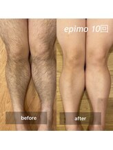 ソルツーサロン マナ(MANA)/脱毛IPL/SHR