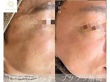 サロンドレナ 名駅店/ハーブピーリング サロンドレナ