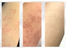 香嬉琉/肌育改善★乾燥肌、肌荒れ湿疹に