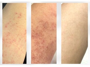 香嬉琉/肌育改善★乾燥肌、肌荒れ湿疹に