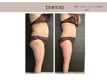 ミライ 福岡春日店(mirai)/お腹、太ももヒップ