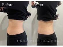 フラットベリー 恵比寿(Flat BELLY)の雰囲気（【施術例】下腹マイナス3cm/究極のお腹集中ケア120分コース1回）