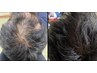 【本気の頭皮集中】冷凍幹細胞上清液4アンプル。深刻な抜け毛に限界集中導入
