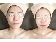 メディカルサロン かとれあ/リフト