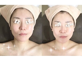 メディカルサロン かとれあ/リフト