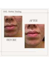 ラノン(Ranon)/ダウンタイムなし／即メイクOK