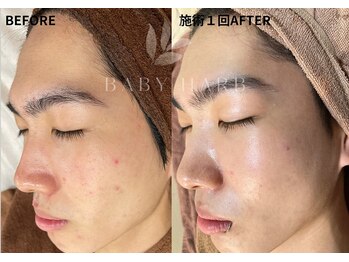 フィズ 府中店(FIS)/☆ハーブピーリング☆都度払い 