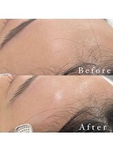 アイルーム 大宮店(eyeroom)/お顔の脱毛も行えます.*