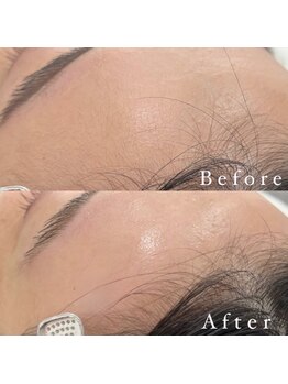 アイルーム 大宮店(eyeroom)/お顔の脱毛も行えます.*