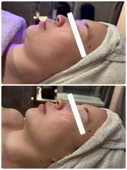 アメリオレ(ameliorer)/αIPLUS 光フェイシャル