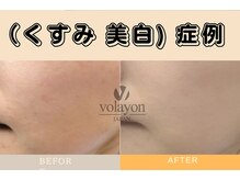 ザ ピーチ(THE PEACH)/韓国最高品質の美白ケア
