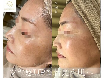 サロンドレナ 名駅店/ハーブピーリング サロンドレナ