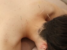 ハリノヒ 本町院/ストレートネック改善鍼灸整体