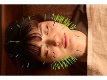 シン(SHINE)/美容鍼